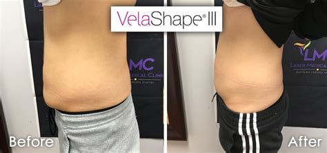 velashape detroit